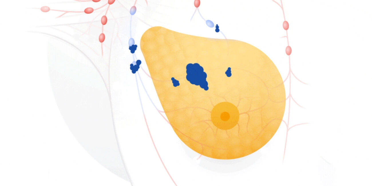La inteligencia artificial de Google podría detectar el cáncer de mama con mayor precisión